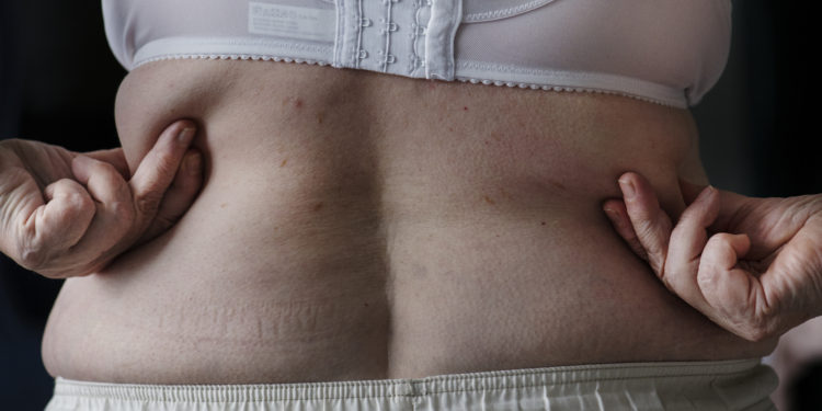 Descubra como remover a gordurinha localizada do abdômen