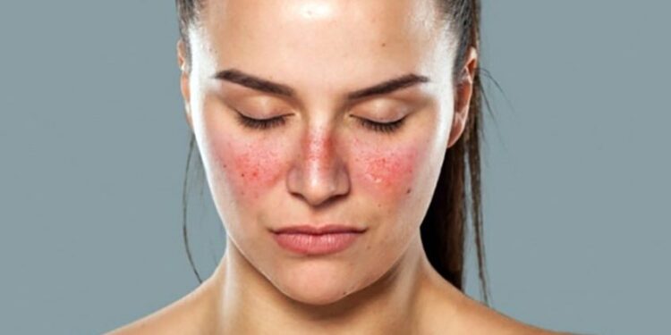 Dia Mundial do Lúpus