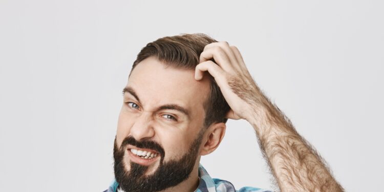 Caspa: sabe o que é, e como tratar?