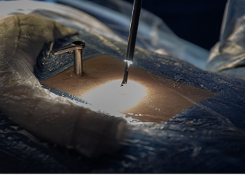 Cirurgia Endoscópica da Coluna no Rol da ANS