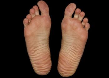 Disidrose: o que é e como tratar