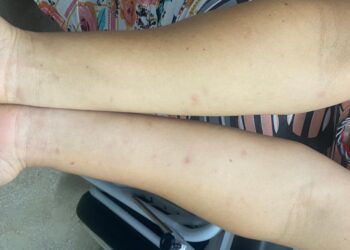 PE: Descoberta causa do prurido epidêmico