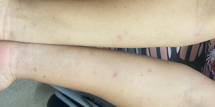 PE: Descoberta causa do prurido epidêmico