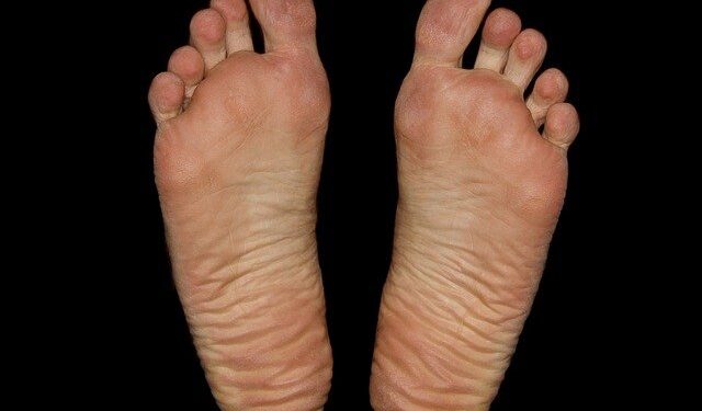 Teste rápido gratuito para hanseníase