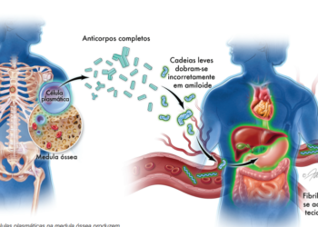 Amiloidose: já ouviu falar ou sabe o que é?