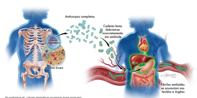 Amiloidose: já ouviu falar ou sabe o que é?