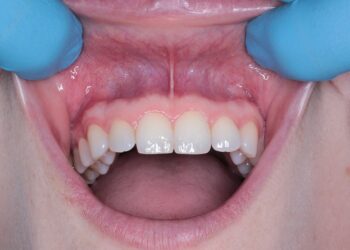 Doenças autoimunes podem afetar a saúde bucal