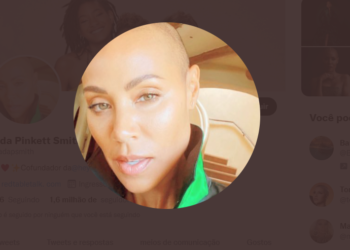 Entendendo a alopecia  e a queda de cabelo excessiva