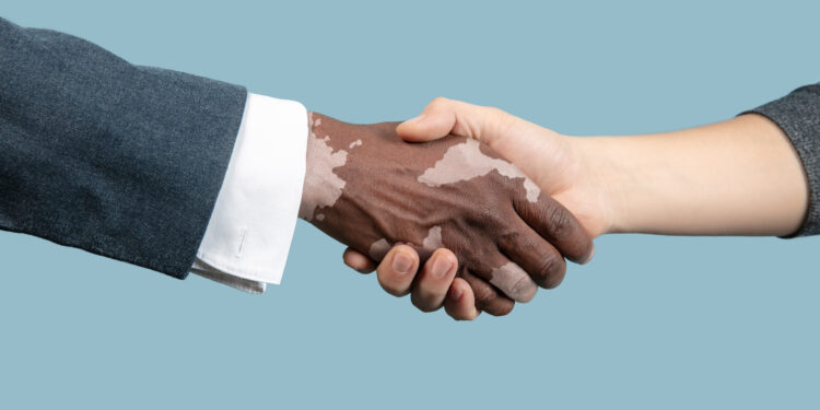 Vitiligo acomete mais de um milhão de brasileiros
