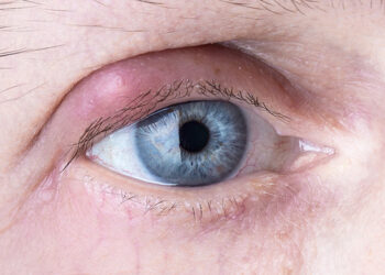 Você sabe o que é terçol ou hordéolo?