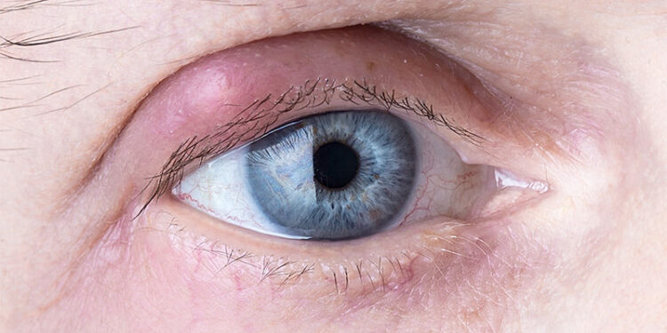 Você sabe o que é terçol ou hordéolo?