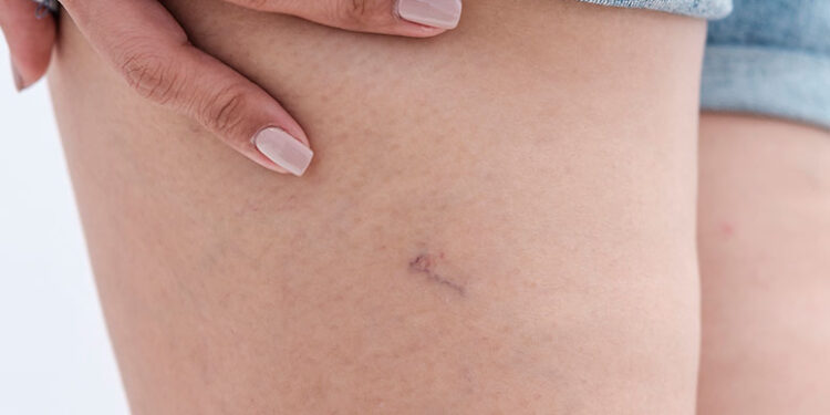 Microvarizes e telangiectasias