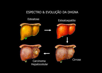 Esteatose Hepática: o que é e como tratar