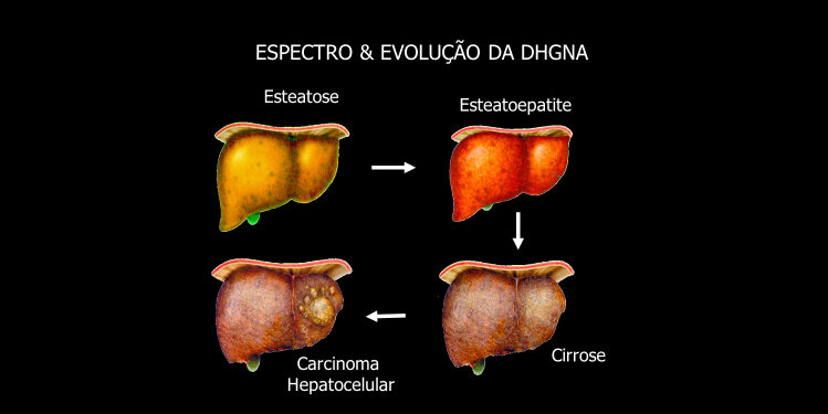 Esteatose Hepática: o que é e como tratar