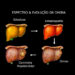 Esteatose Hepática: o que é e como tratar