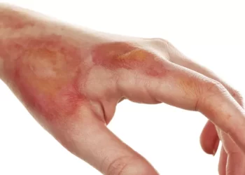 Cresce número de acidentes domésticos