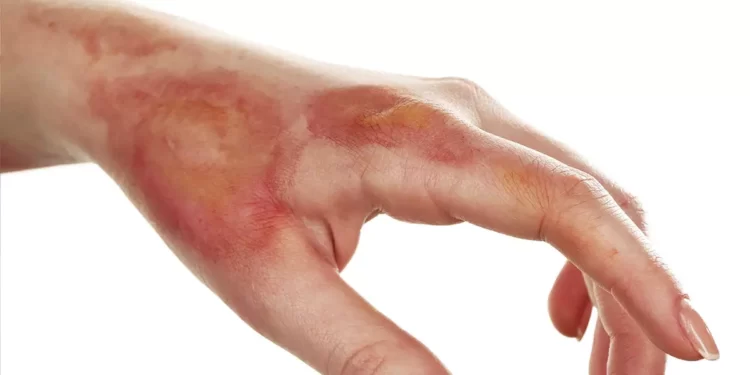 Cresce número de acidentes domésticos