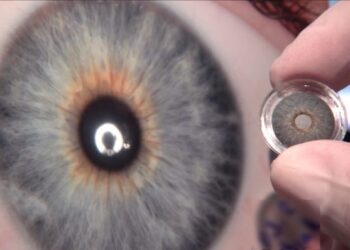 Implante de íris artificial recupera visão e autoestima