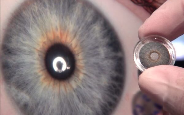 Implante de íris artificial recupera visão e autoestima