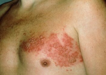 Herpes zóster pode sinalizar outras doenças