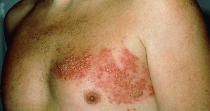 Herpes zóster pode sinalizar outras doenças