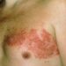 Herpes zóster pode sinalizar outras doenças