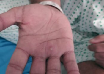 OMS quer união para conter varíola dos macacos