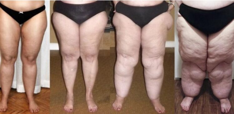 Excesso de gordura localizada x problema vascular