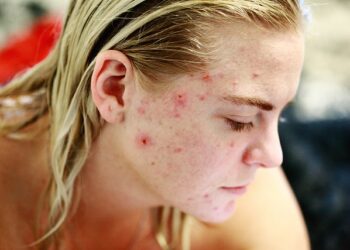 Cicatriz de acne: como prevenir e cuidar?