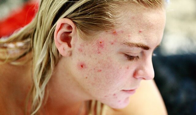 Cicatriz de acne: como prevenir e cuidar?