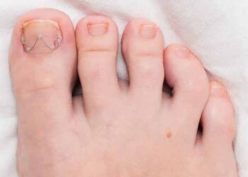 Quando a unha encravada  torna-se um pesadelo