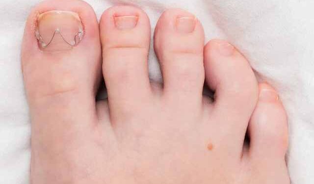 Quando a unha encravada  torna-se um pesadelo