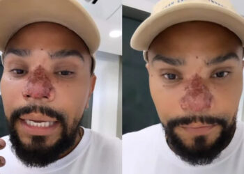 Entenda a necrose após procedimento do cantor Naldo