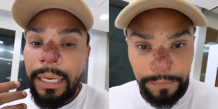 Entenda a necrose após procedimento do cantor Naldo