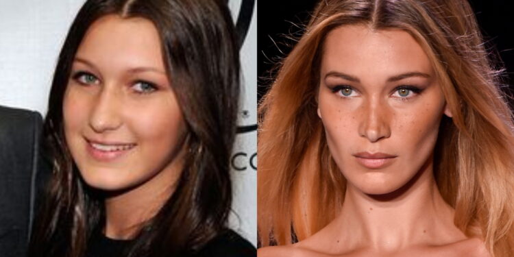 Buccal Fat Removal rouba cena no TikTok