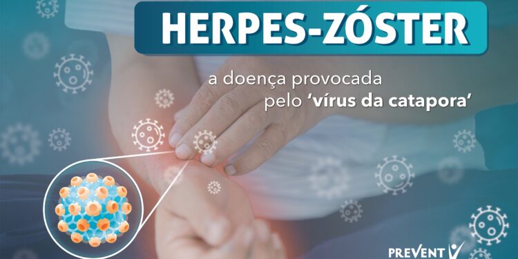 Os sinais da Herpes-Zóster no Adulto+