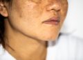 Melasma ou Cloasma: aprenda a diferenciar