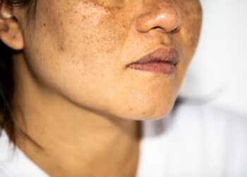 Melasma ou Cloasma: aprenda a diferenciar