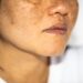 Melasma ou Cloasma: aprenda a diferenciar