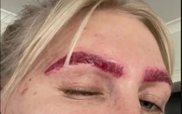 Quer remover a micropigmentação? Cuidado!