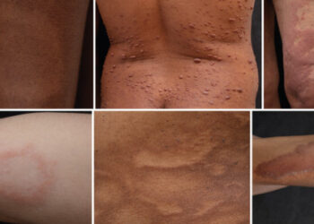 Hanseníase ainda é estigmatizada por brasileiros