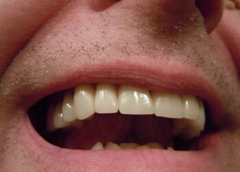 5 hábitos comuns a boca que prejudicam os dentes