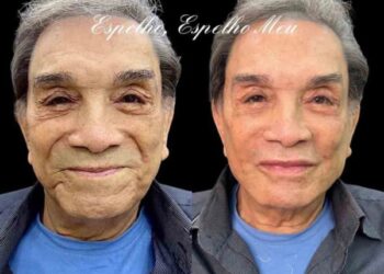 Harmonização facial na terceira idade