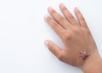 Como remover tatuagens, queloides e cicatrizes