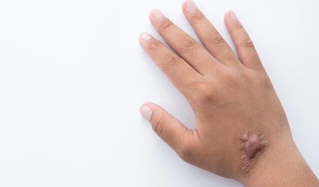 Como remover tatuagens, queloides e cicatrizes