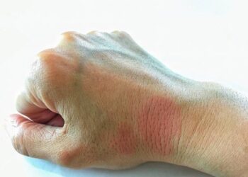 Causas e prevenção do Lúpus