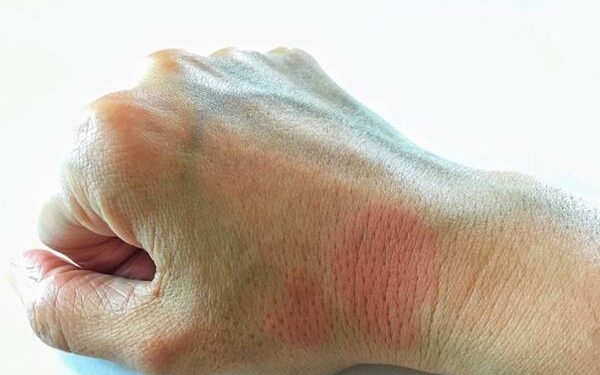 Causas e prevenção do Lúpus