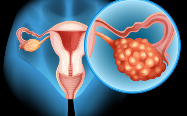 Retirada de ovários e a Doença de Parkinson