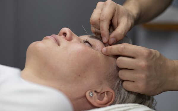 Os benefícios da Acupuntura na Odontologia