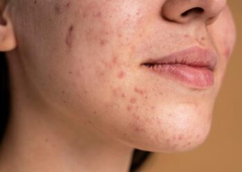 Entenda o que pode causar manchas na pele 